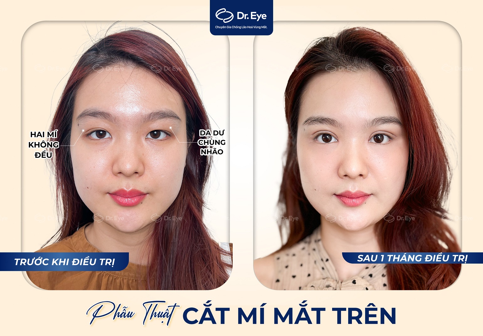 Kết quả cắt mí mắt tại Dr. Eye – Chị Hoàng Nhi, nếp mí đều đẹp tự nhiên